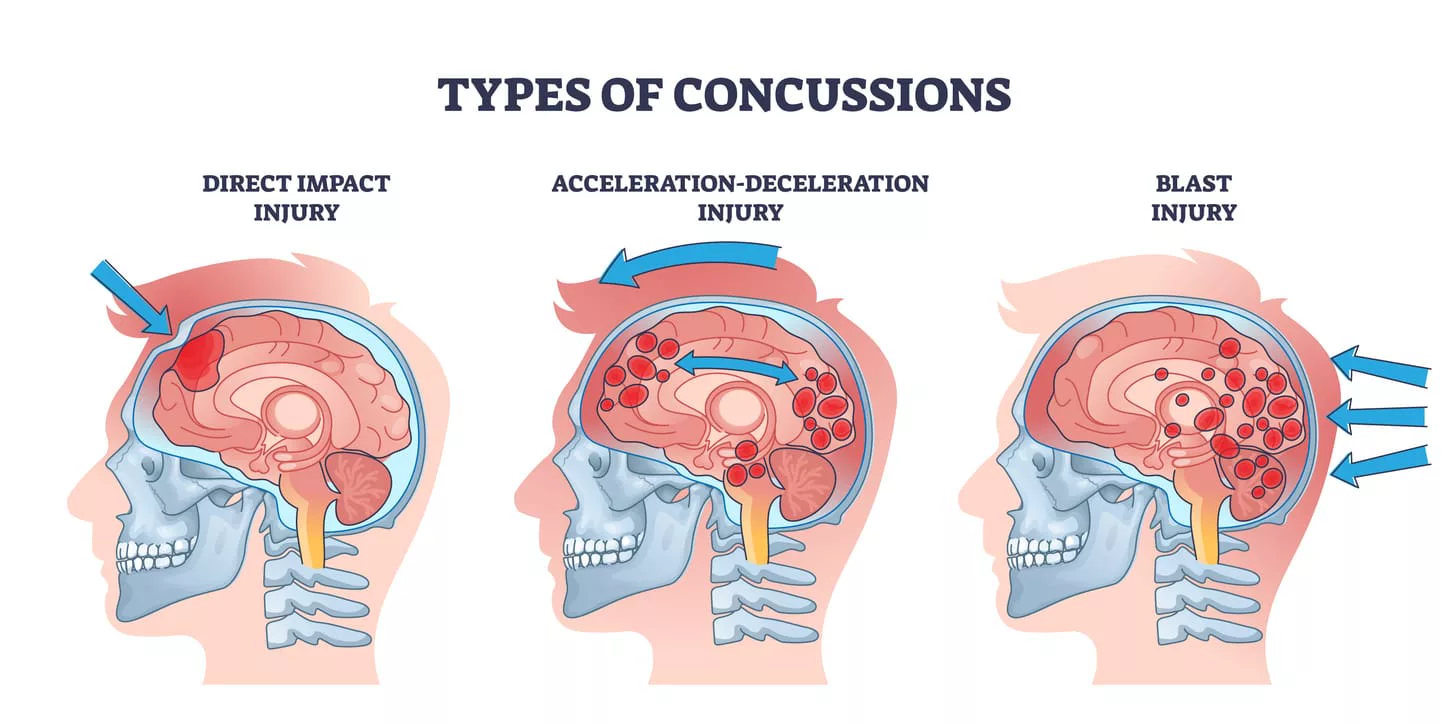 Car accident concussions