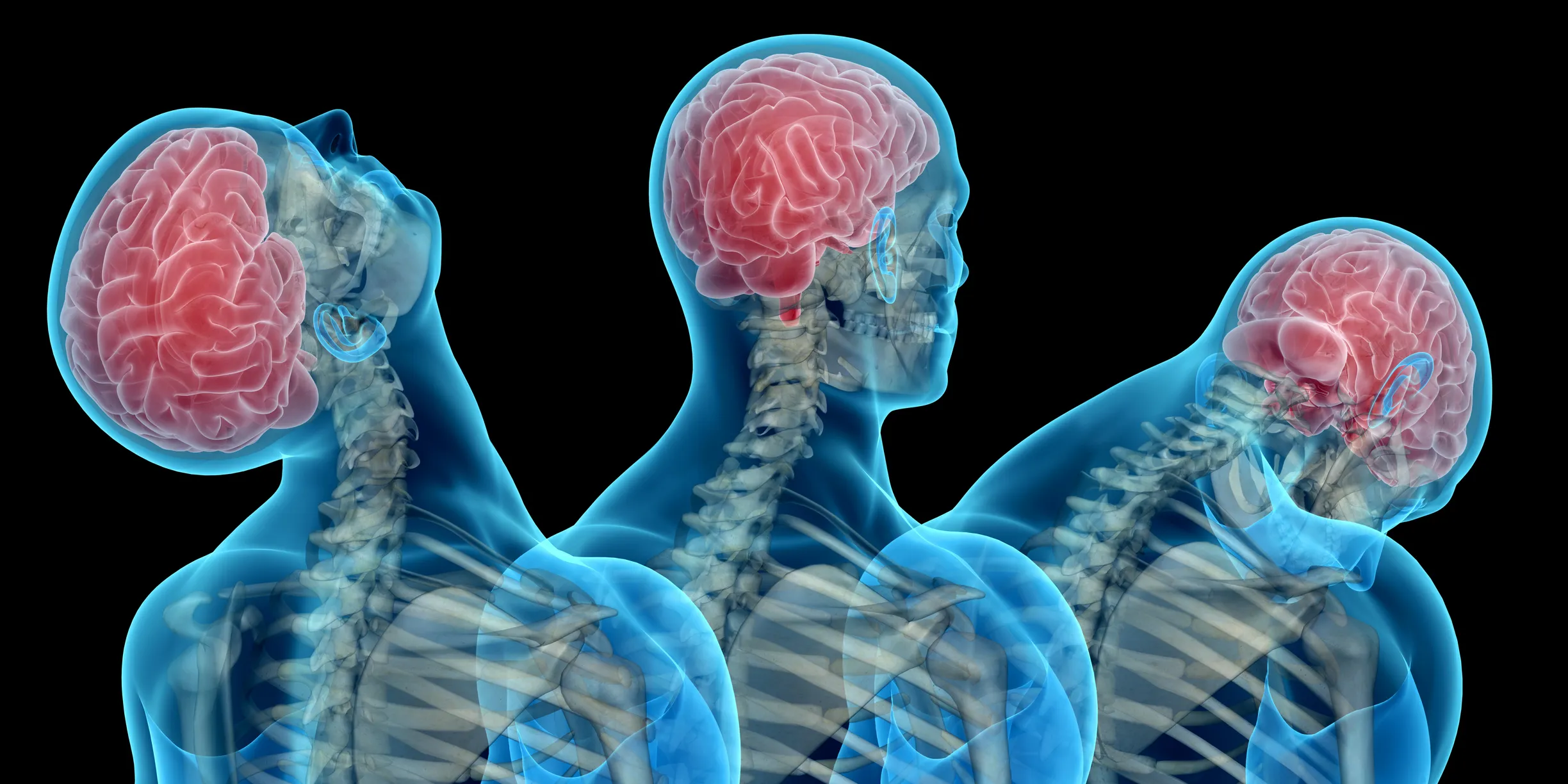 Three views of a head and brain snapping backward, upright, and forward on the neck during a sudden jolt