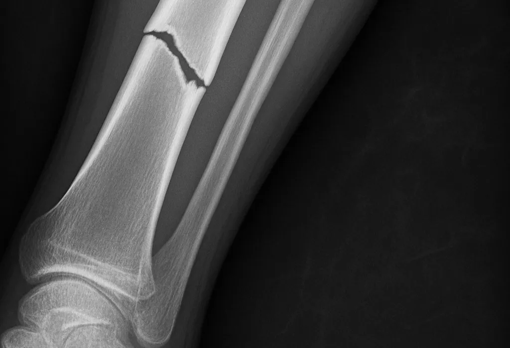 Lower leg x-ray showing a break across the tibia above the ankle, with the thinner fibula running alongside it