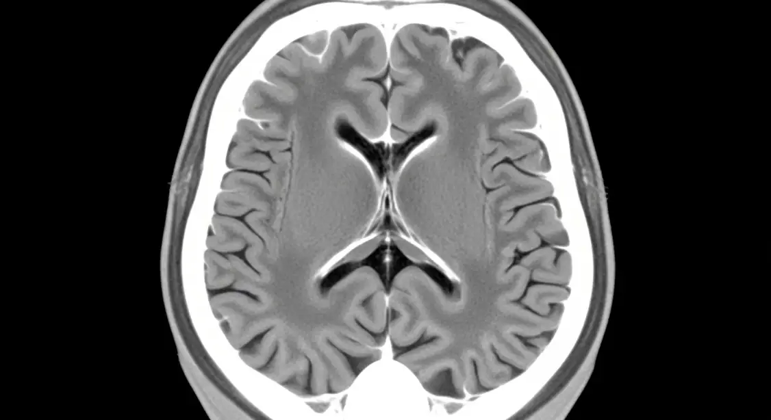 Ct scan of the brain showing no visible damage after a concussion