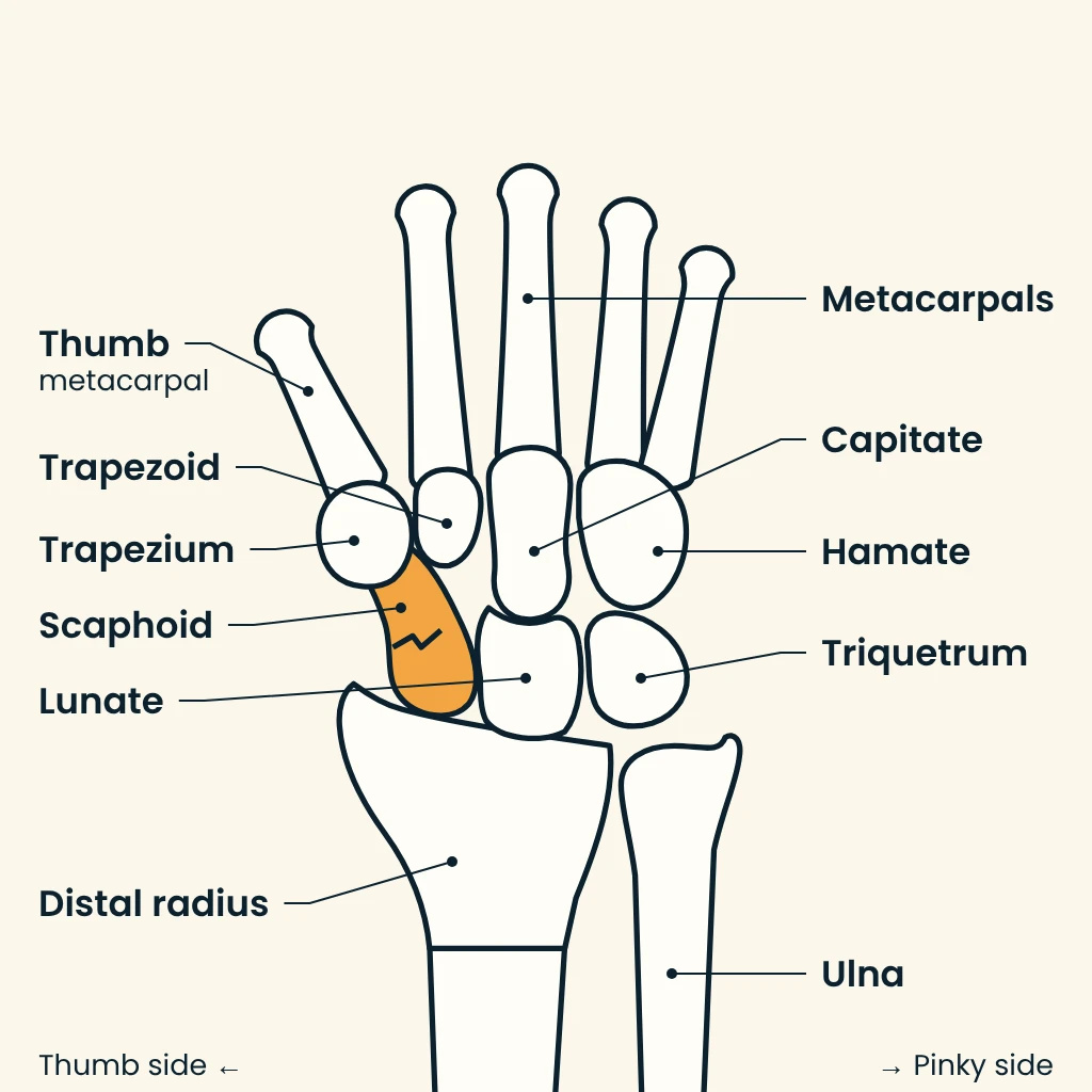 Labeled line drawing of the wrist bones seen from the back of the right hand, with a break drawn across the scaphoid